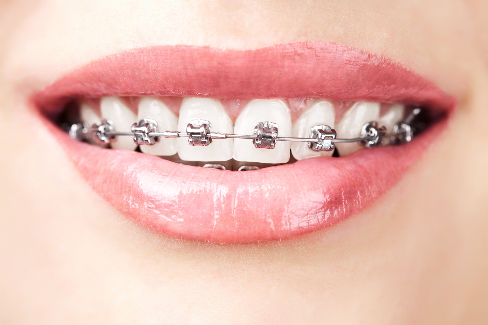 Teeth,With,Braces